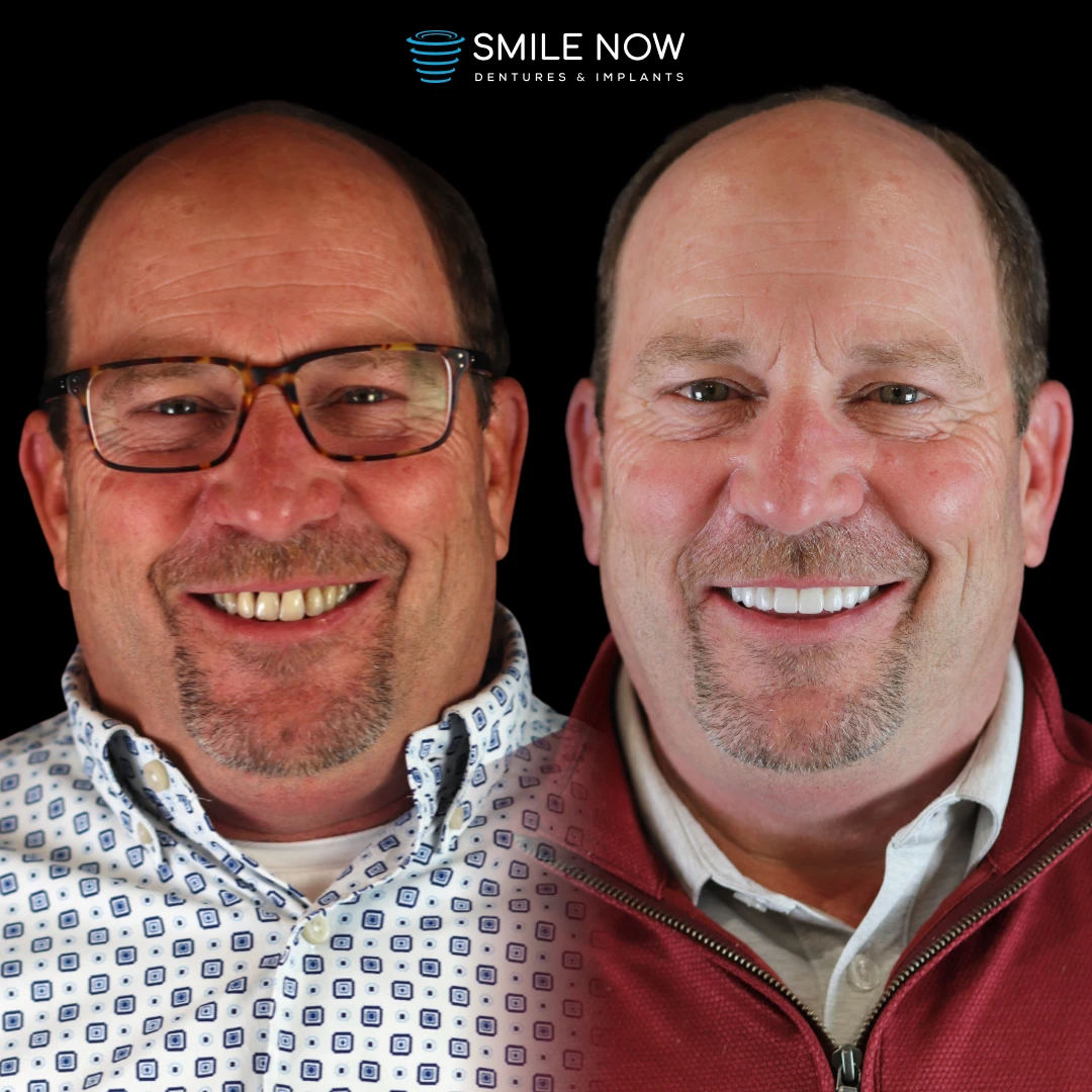Dental implants before and after transformation with full mouth dental implant procedures