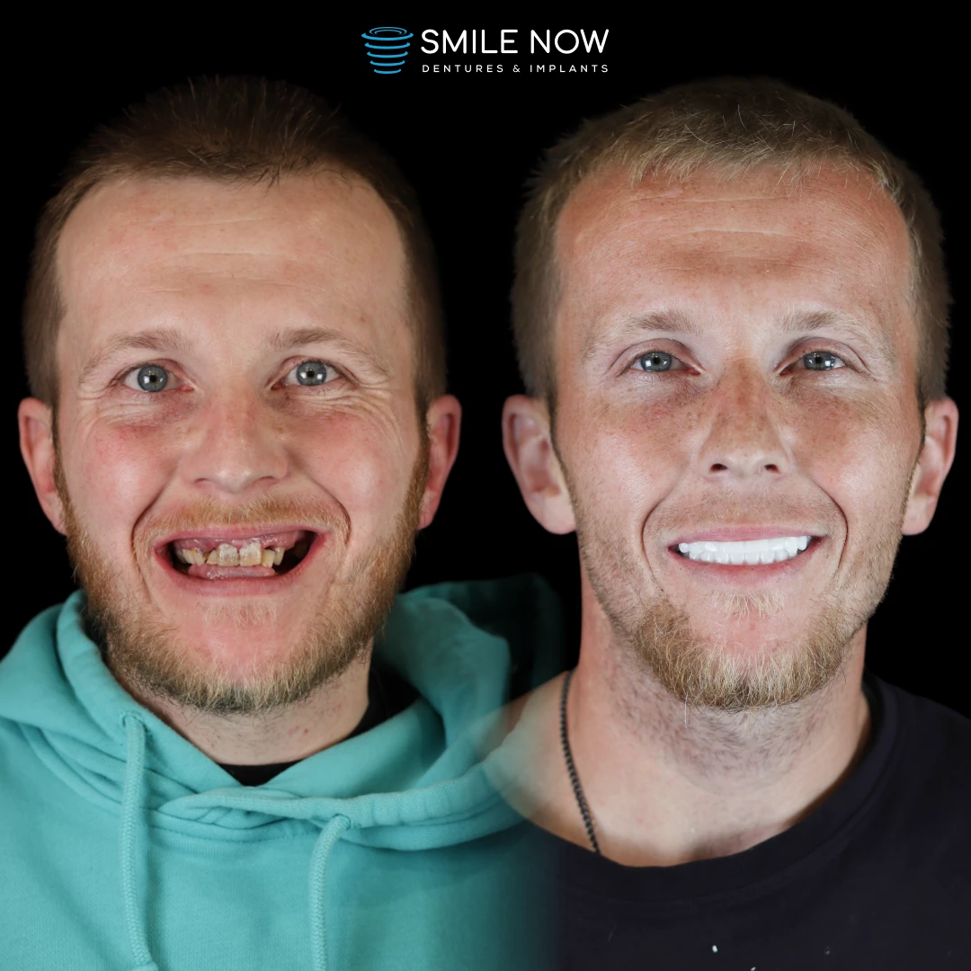 Dental implants before and after transformation with full mouth dental implant procedures
