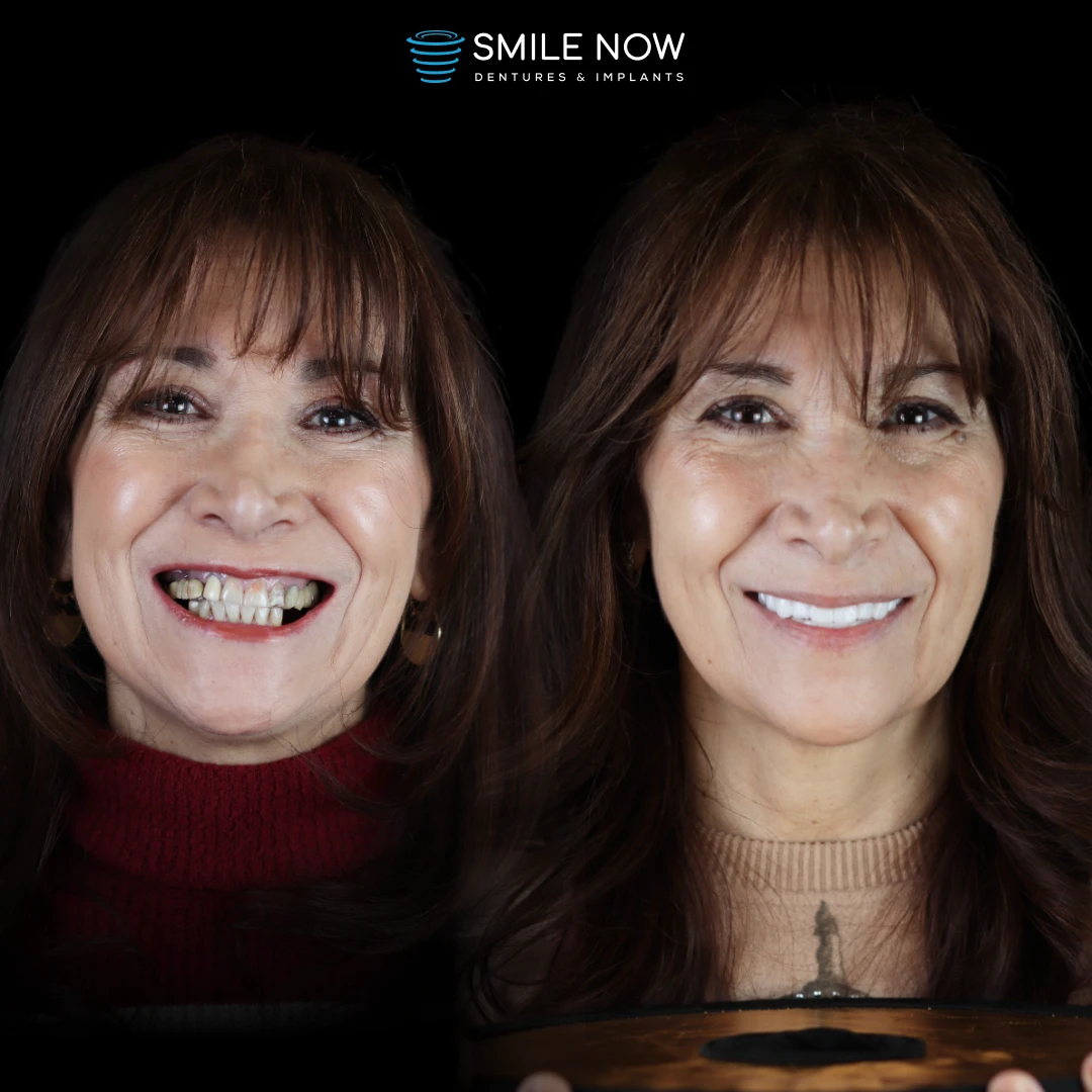 Dental implants before and after transformation with full mouth dental implant procedures